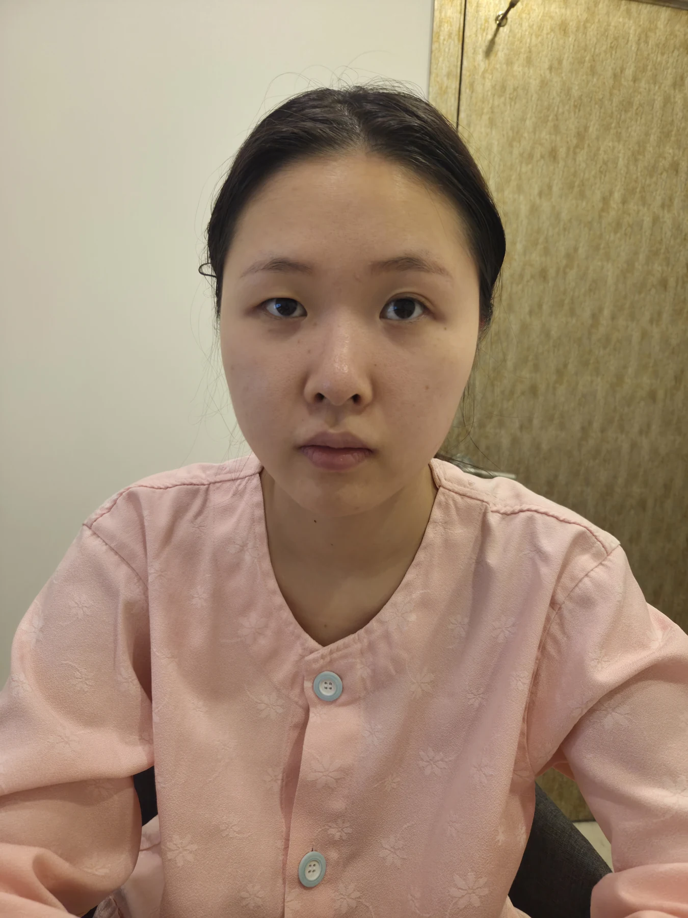 Wonder canthoplasty and eye-area surgery: six-month photo record · Case 063 at Answer Plastic Surgery. Front view — before, wonder canthoplasty and eye-area surgery at Answer Plastic Surgery (case 063).