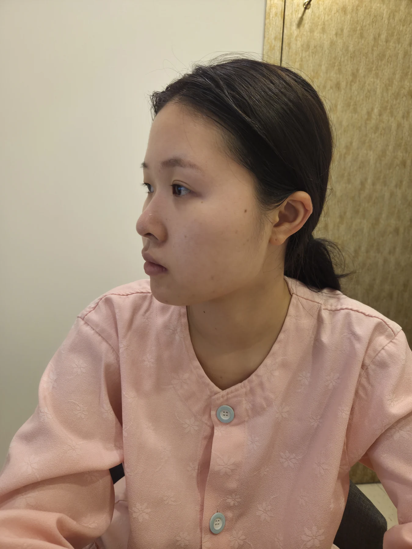 Wonder canthoplasty and eye-area surgery: six-month photo record · Case 063 at Answer Plastic Surgery. Opposite three-quarter view — before, wonder canthoplasty and eye-area surgery at Answer Plastic Surgery (case 063).