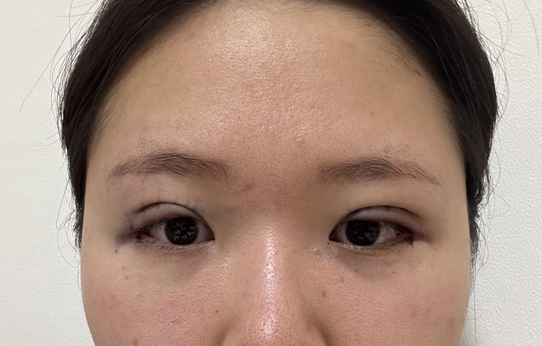 Wonder canthoplasty and eye-area surgery: six-month photo record · Case 063 at Answer Plastic Surgery. Front view — day of surgery, wonder canthoplasty and eye-area surgery at Answer Plastic Surgery (case 063).