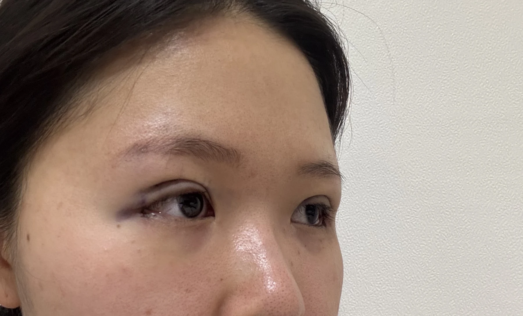 Wonder canthoplasty and eye-area surgery: six-month photo record · Case 063 at Answer Plastic Surgery. Three-quarter view — day of surgery, wonder canthoplasty and eye-area surgery at Answer Plastic Surgery (case 063).