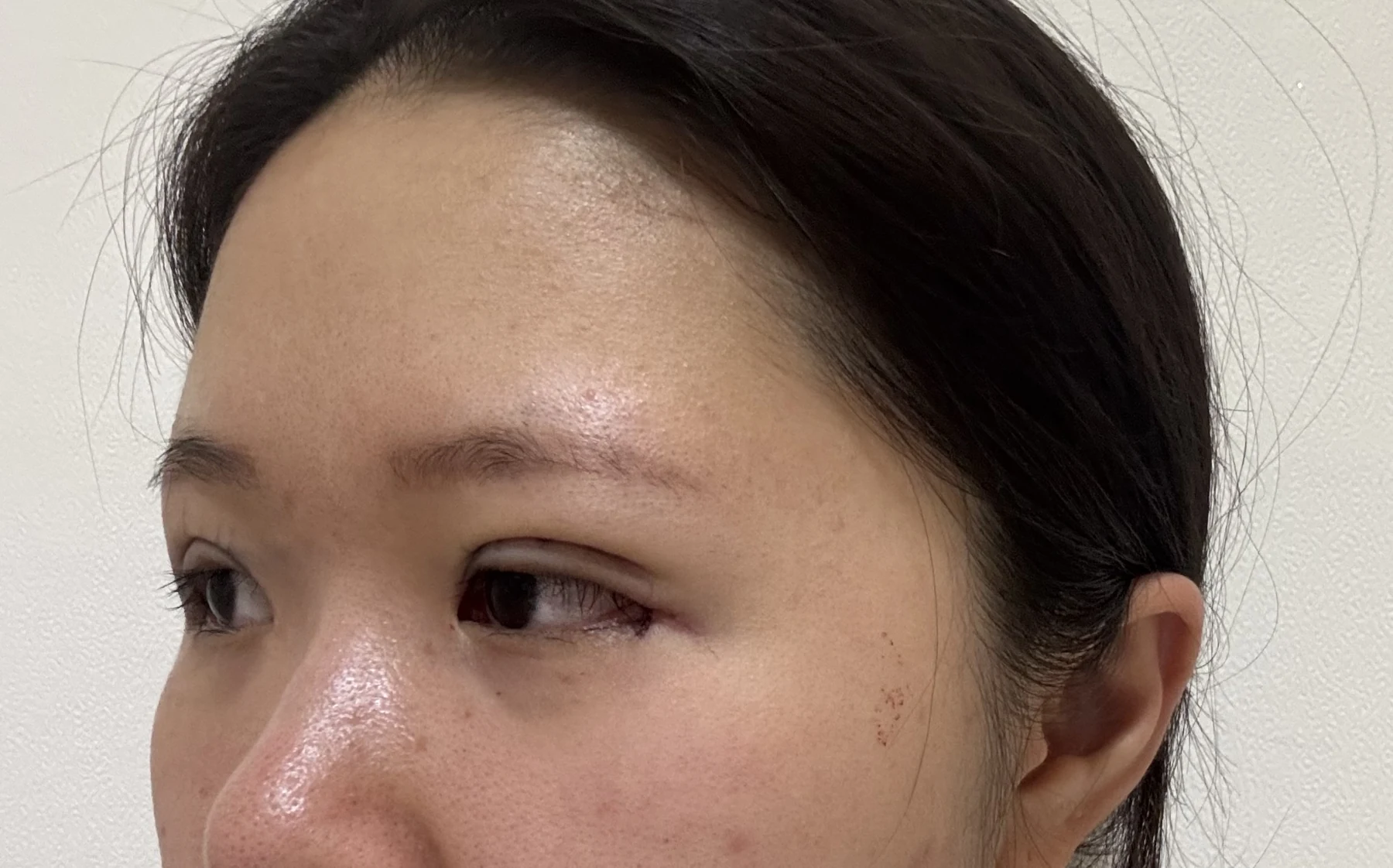 Wonder canthoplasty and eye-area surgery: six-month photo record · Case 063 at Answer Plastic Surgery. Opposite three-quarter view — day of surgery, wonder canthoplasty and eye-area surgery at Answer Plastic Surgery (case 063).