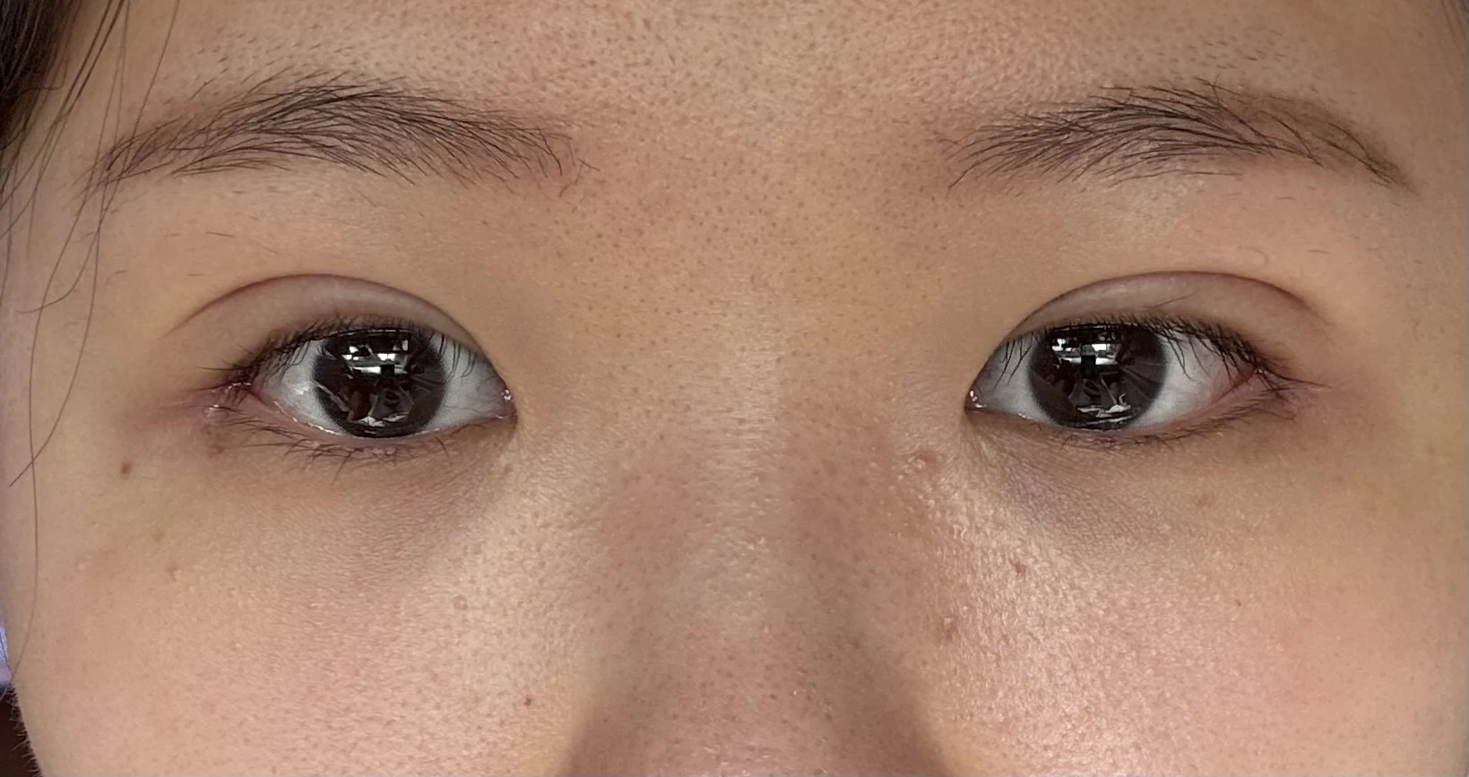 Wonder canthoplasty and eye-area surgery: six-month photo record · Case 063 at Answer Plastic Surgery. Front view — 1 week, wonder canthoplasty and eye-area surgery at Answer Plastic Surgery (case 063).