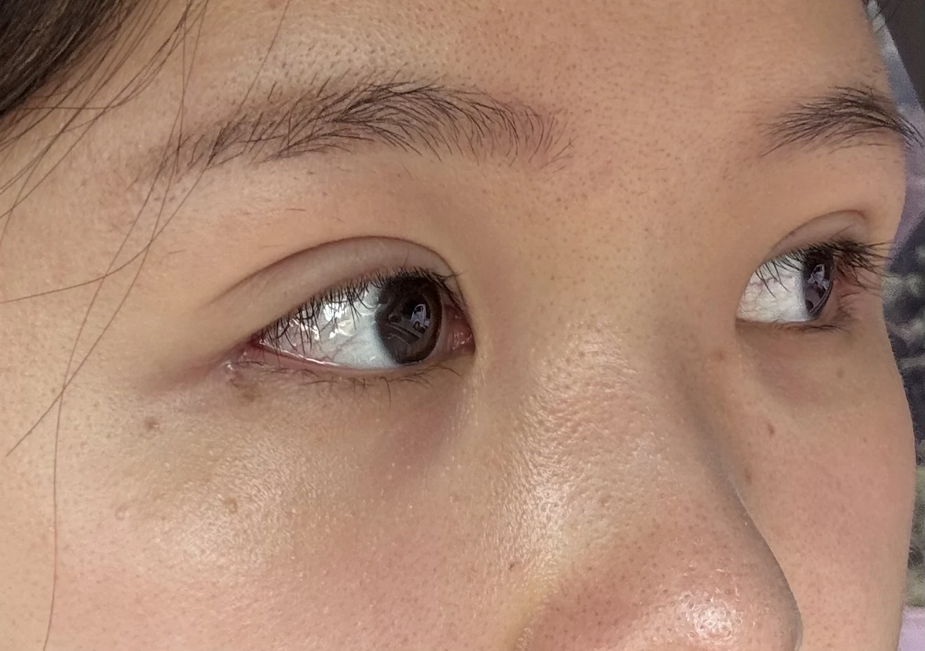 Wonder canthoplasty and eye-area surgery: six-month photo record · Case 063 at Answer Plastic Surgery. Three-quarter view — 1 week, wonder canthoplasty and eye-area surgery at Answer Plastic Surgery (case 063).
