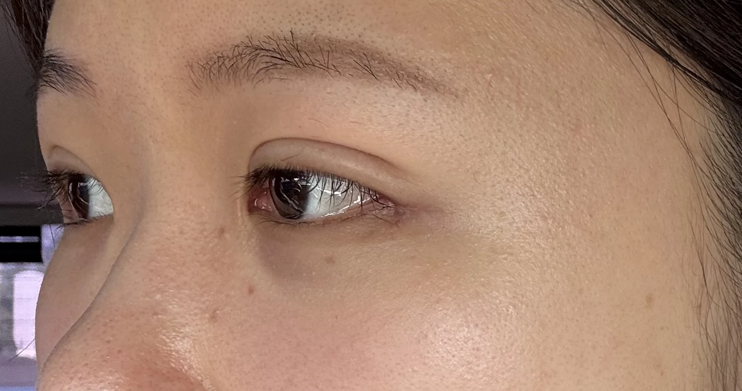 Wonder canthoplasty and eye-area surgery: six-month photo record · Case 063 at Answer Plastic Surgery. Opposite three-quarter view — 1 week, wonder canthoplasty and eye-area surgery at Answer Plastic Surgery (case 063).