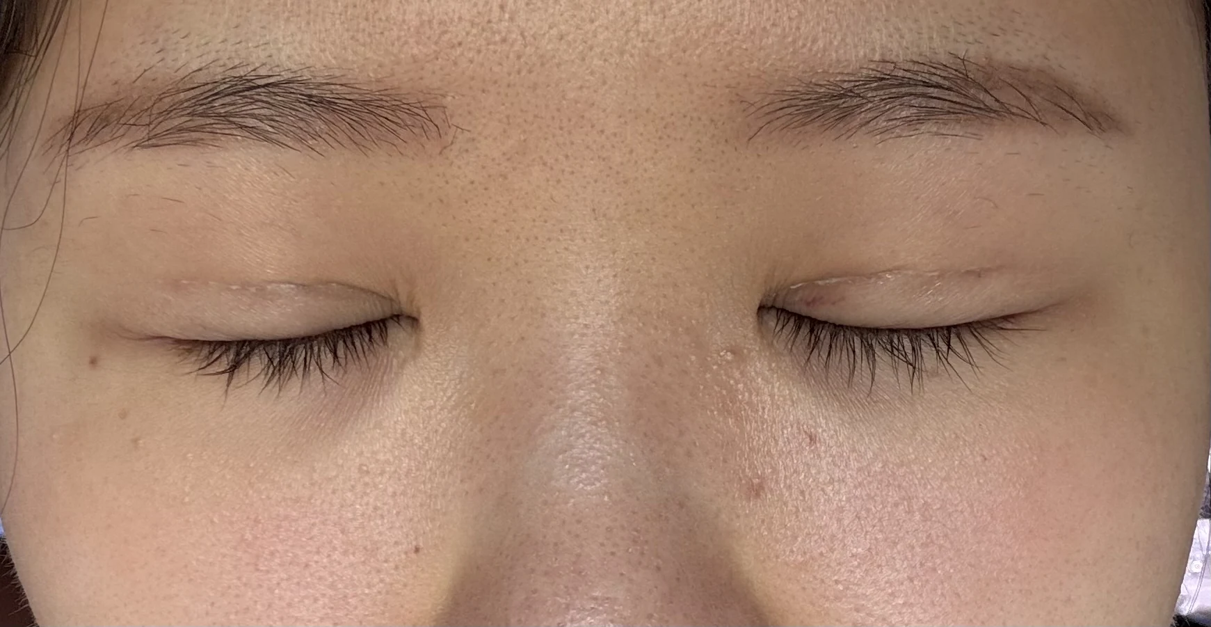 Wonder canthoplasty and eye-area surgery: six-month photo record · Case 063 at Answer Plastic Surgery. Eyes closed — 1 week, wonder canthoplasty and eye-area surgery at Answer Plastic Surgery (case 063).