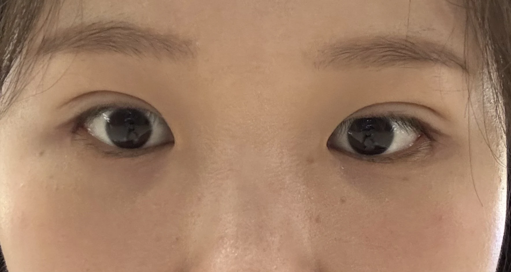 Wonder canthoplasty and eye-area surgery: six-month photo record · Case 063 at Answer Plastic Surgery. Front view — 2 weeks, wonder canthoplasty and eye-area surgery at Answer Plastic Surgery (case 063).