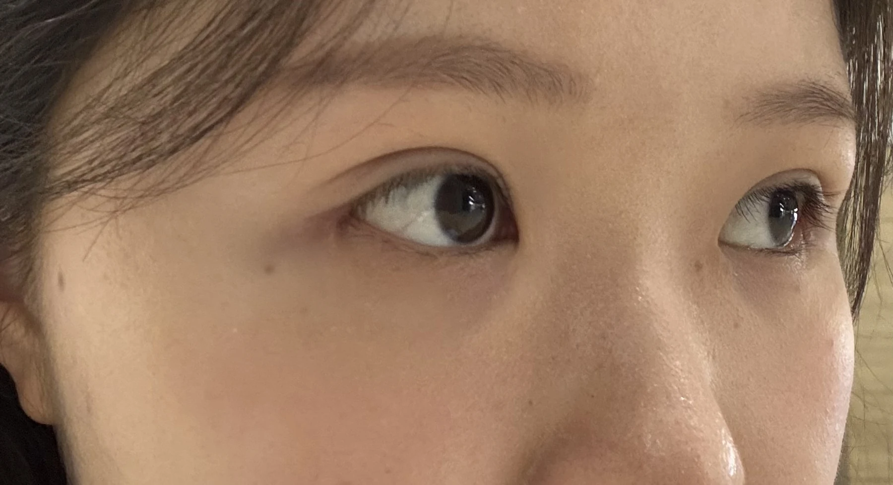 Wonder canthoplasty and eye-area surgery: six-month photo record · Case 063 at Answer Plastic Surgery. Three-quarter view — 2 weeks, wonder canthoplasty and eye-area surgery at Answer Plastic Surgery (case 063).