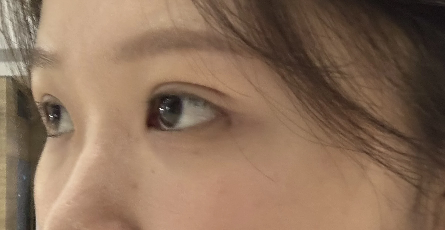 Wonder canthoplasty and eye-area surgery: six-month photo record · Case 063 at Answer Plastic Surgery. Opposite three-quarter view — 2 weeks, wonder canthoplasty and eye-area surgery at Answer Plastic Surgery (case 063).