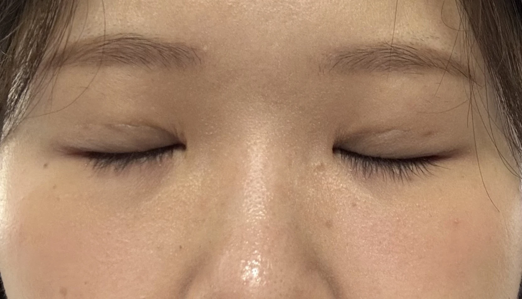 Wonder canthoplasty and eye-area surgery: six-month photo record · Case 063 at Answer Plastic Surgery. Eyes closed — 2 weeks, wonder canthoplasty and eye-area surgery at Answer Plastic Surgery (case 063).