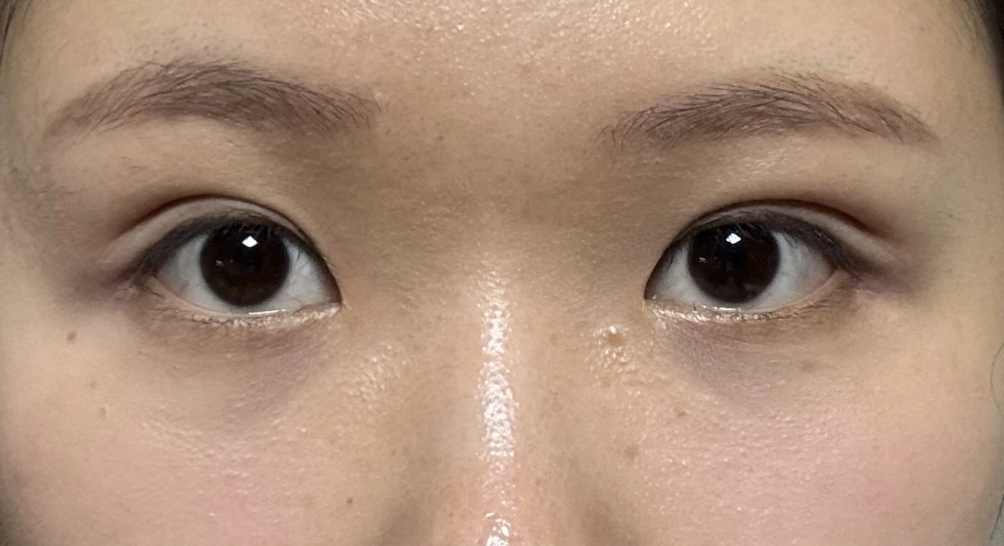 Wonder canthoplasty and eye-area surgery: six-month photo record · Case 063 at Answer Plastic Surgery. Front view — 1 month, wonder canthoplasty and eye-area surgery at Answer Plastic Surgery (case 063).