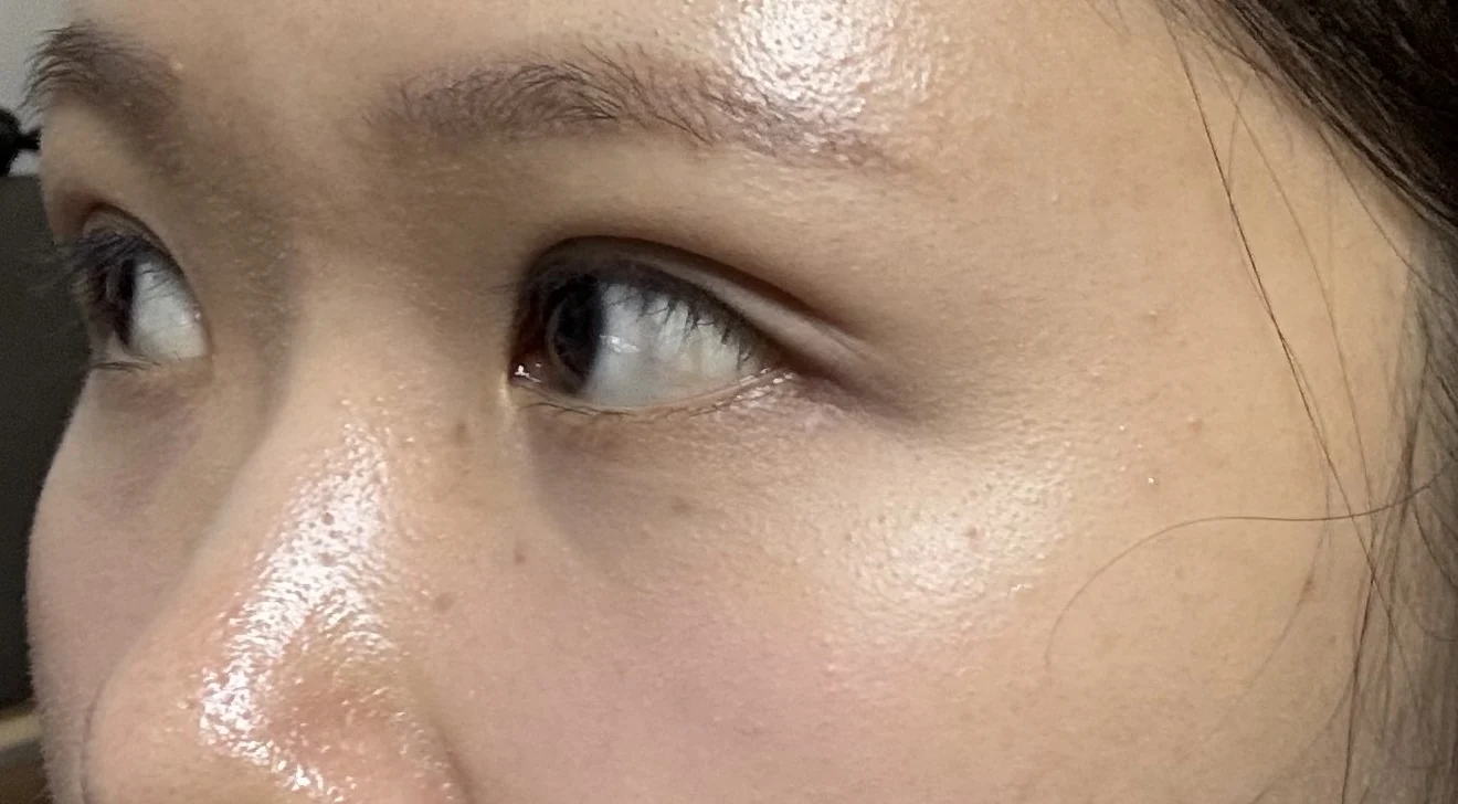 Wonder canthoplasty and eye-area surgery: six-month photo record · Case 063 at Answer Plastic Surgery. Three-quarter view — 1 month, wonder canthoplasty and eye-area surgery at Answer Plastic Surgery (case 063).