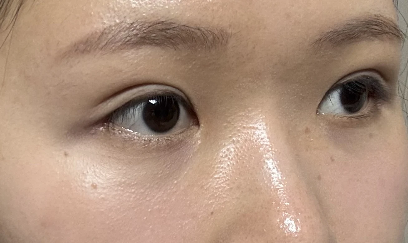 Wonder canthoplasty and eye-area surgery: six-month photo record · Case 063 at Answer Plastic Surgery. Opposite three-quarter view — 1 month, wonder canthoplasty and eye-area surgery at Answer Plastic Surgery (case 063).