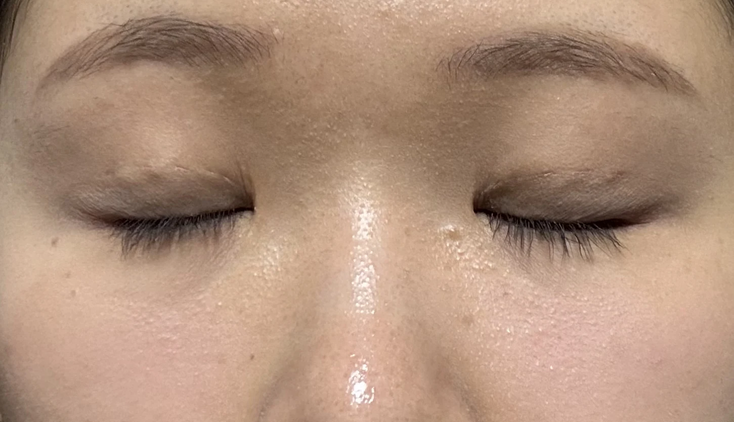 Wonder canthoplasty and eye-area surgery: six-month photo record · Case 063 at Answer Plastic Surgery. Eyes closed — 1 month, wonder canthoplasty and eye-area surgery at Answer Plastic Surgery (case 063).