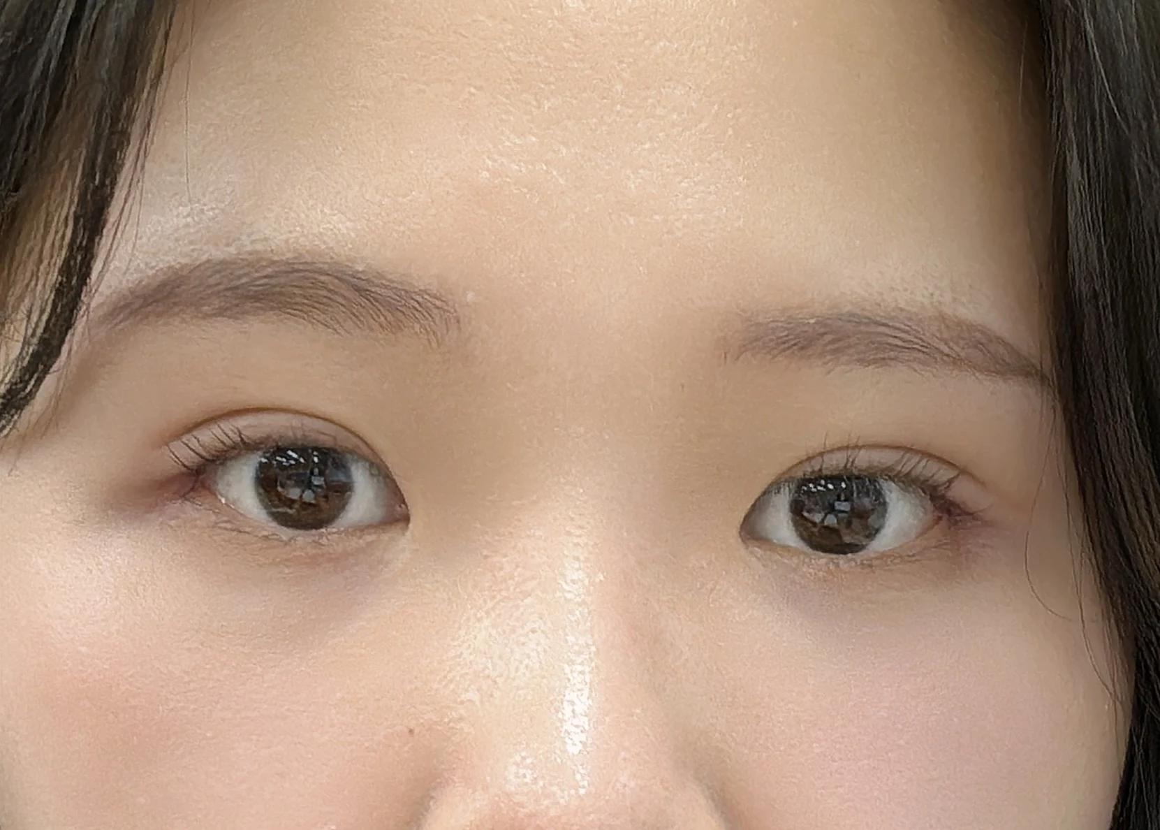 Wonder canthoplasty and eye-area surgery: six-month photo record · Case 063 at Answer Plastic Surgery. Front view — 2 months, wonder canthoplasty and eye-area surgery at Answer Plastic Surgery (case 063).