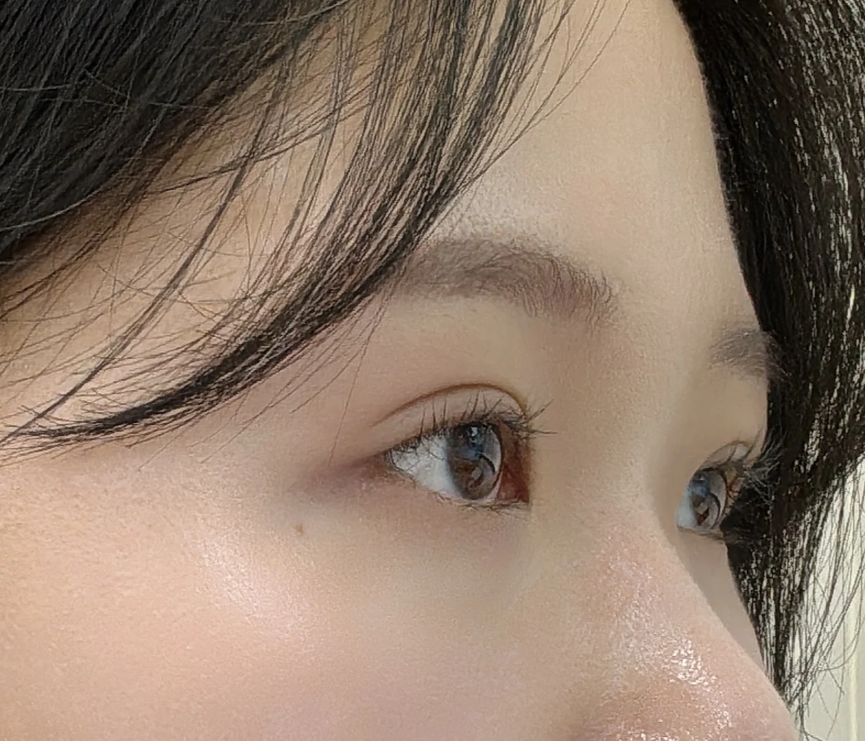 Wonder canthoplasty and eye-area surgery: six-month photo record · Case 063 at Answer Plastic Surgery. Three-quarter view — 2 months, wonder canthoplasty and eye-area surgery at Answer Plastic Surgery (case 063).