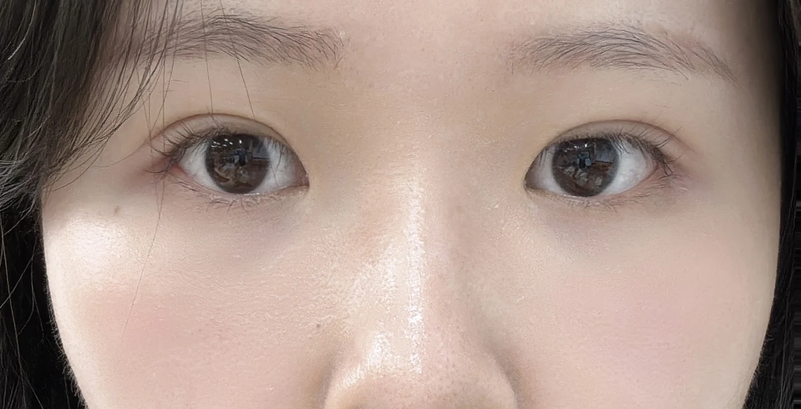 Wonder canthoplasty and eye-area surgery: six-month photo record · Case 063 at Answer Plastic Surgery. Front view — 3 months, wonder canthoplasty and eye-area surgery at Answer Plastic Surgery (case 063).