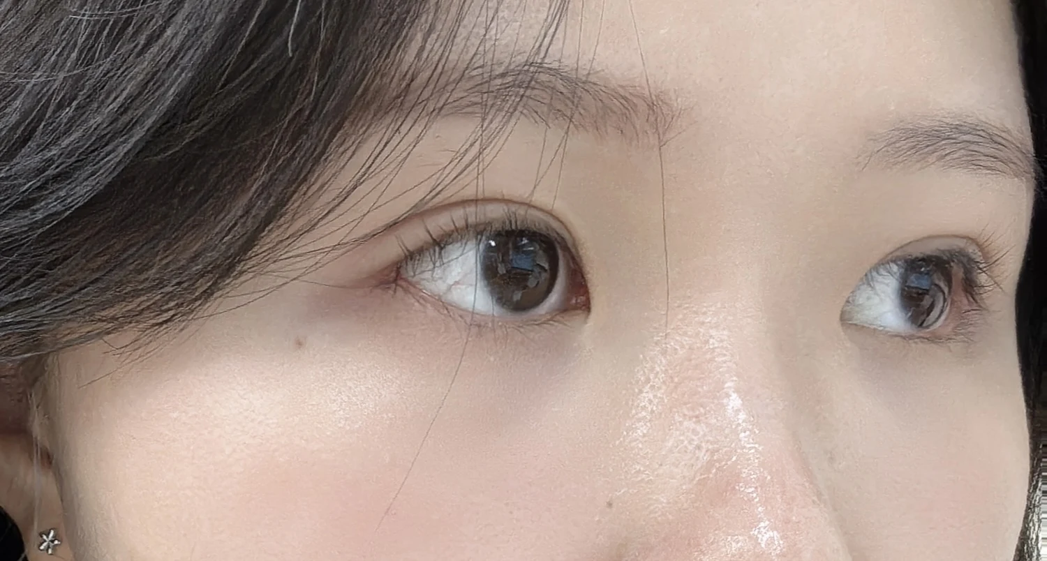 Wonder canthoplasty and eye-area surgery: six-month photo record · Case 063 at Answer Plastic Surgery. Three-quarter view — 3 months, wonder canthoplasty and eye-area surgery at Answer Plastic Surgery (case 063).