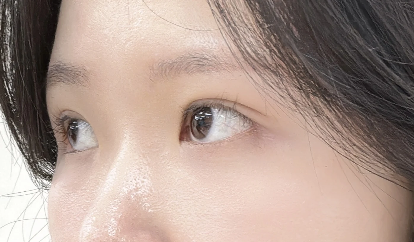 Wonder canthoplasty and eye-area surgery: six-month photo record · Case 063 at Answer Plastic Surgery. Opposite three-quarter view — 3 months, wonder canthoplasty and eye-area surgery at Answer Plastic Surgery (case 063).
