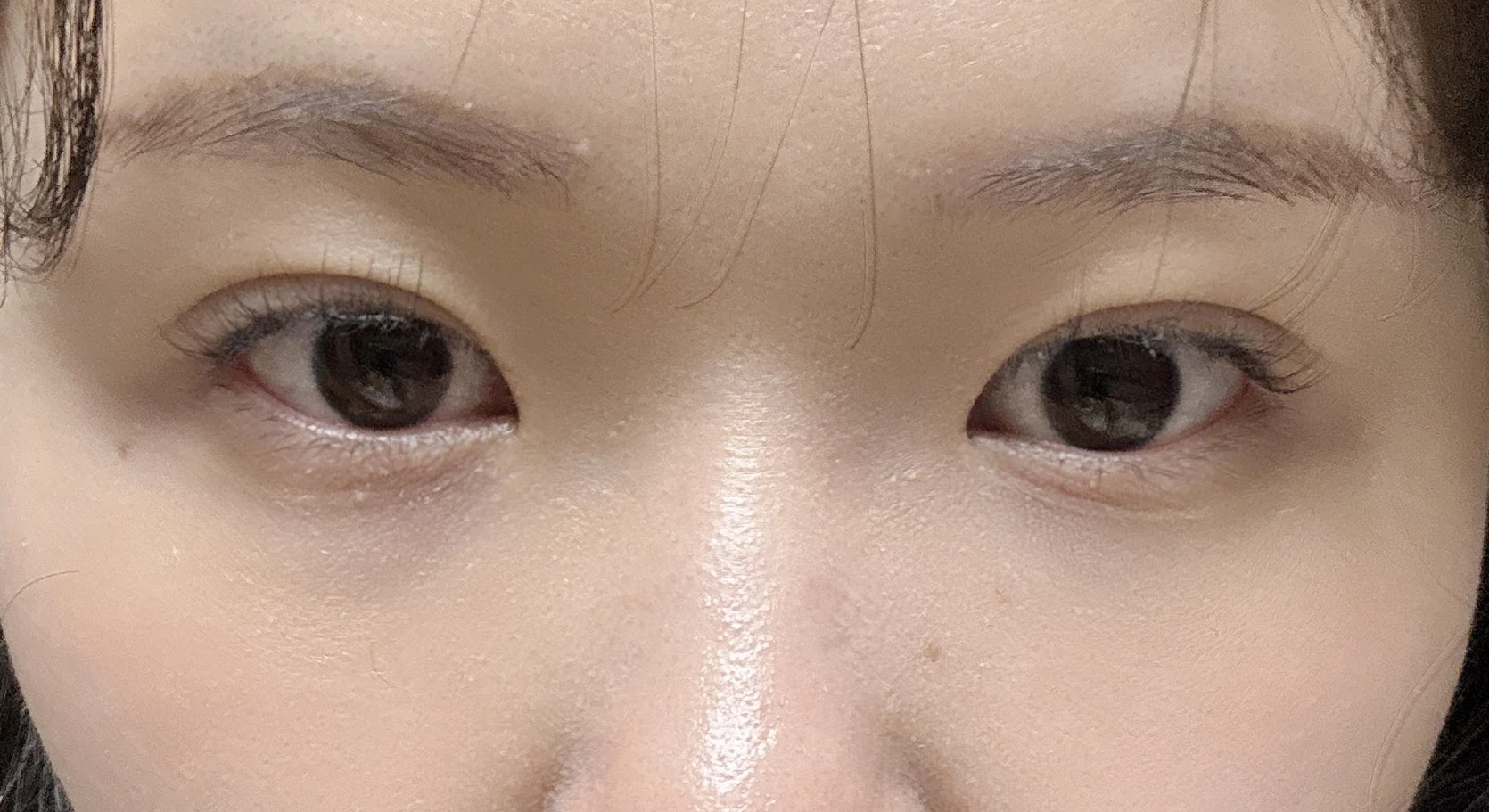 Wonder canthoplasty and eye-area surgery: six-month photo record · Case 063 at Answer Plastic Surgery. Front view — 6 months, wonder canthoplasty and eye-area surgery at Answer Plastic Surgery (case 063).
