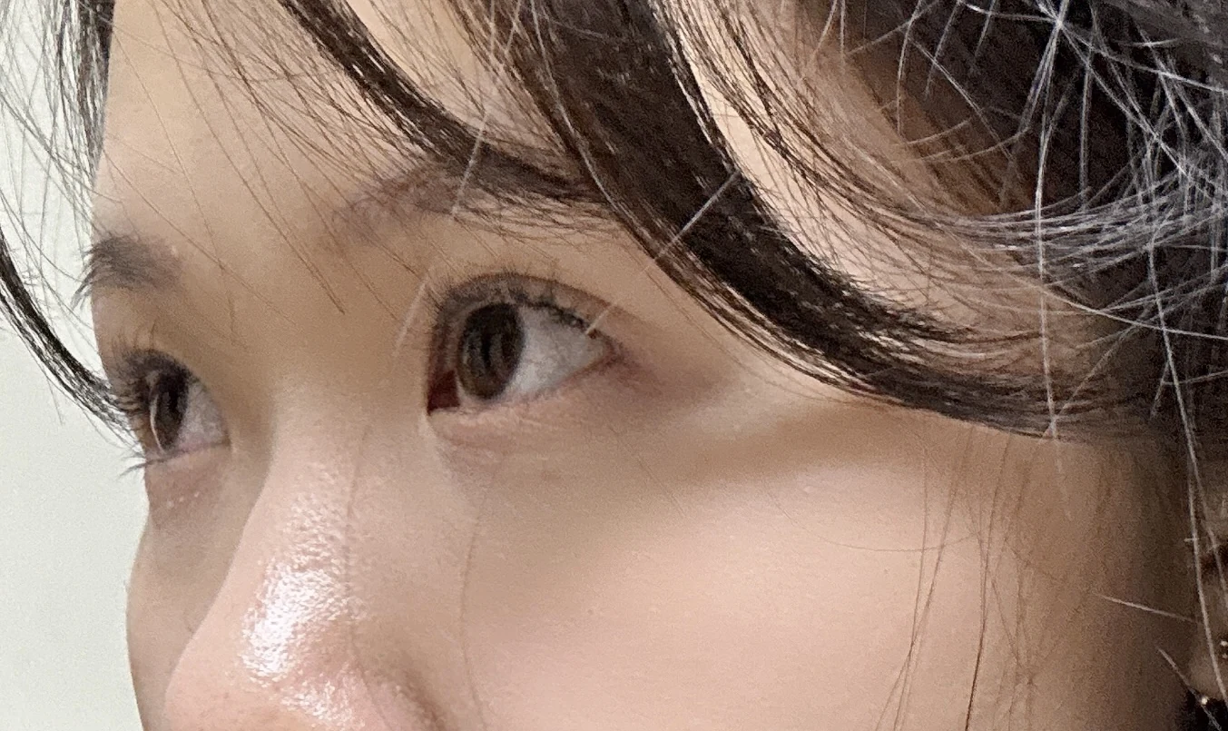 Wonder canthoplasty and eye-area surgery: six-month photo record · Case 063 at Answer Plastic Surgery. Three-quarter view — 6 months, wonder canthoplasty and eye-area surgery at Answer Plastic Surgery (case 063).