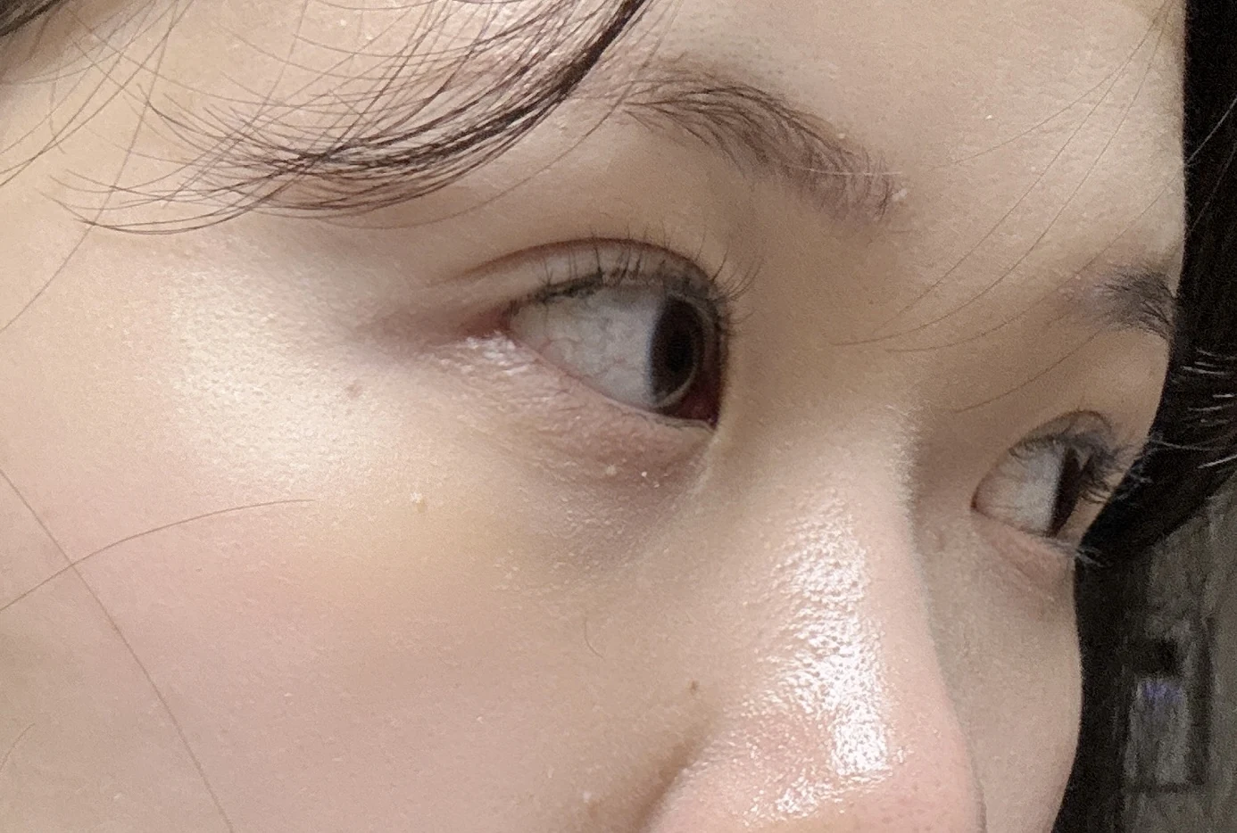 Wonder canthoplasty and eye-area surgery: six-month photo record · Case 063 at Answer Plastic Surgery. Opposite three-quarter view — 6 months, wonder canthoplasty and eye-area surgery at Answer Plastic Surgery (case 063).