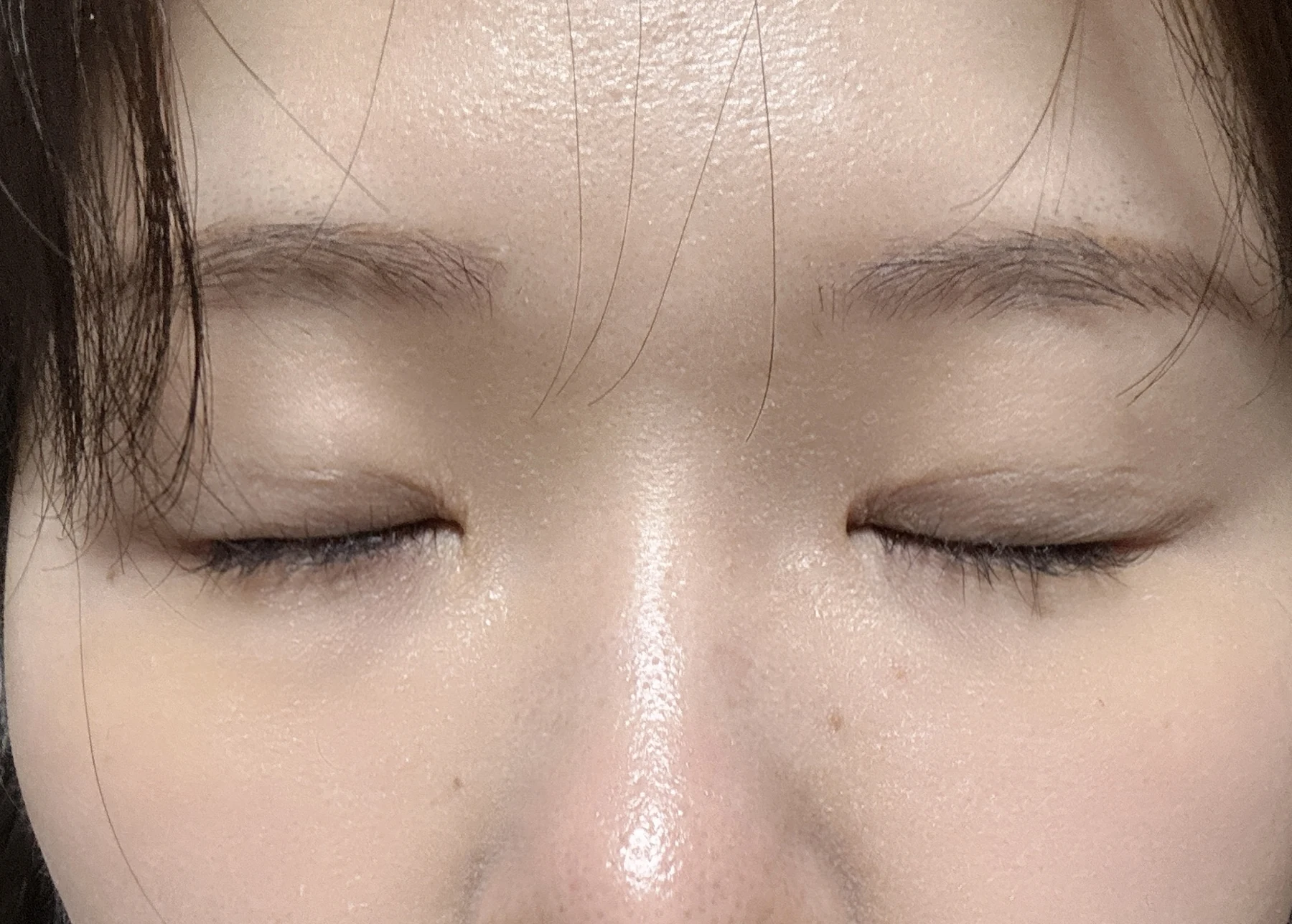 Wonder canthoplasty and eye-area surgery: six-month photo record · Case 063 at Answer Plastic Surgery. Eyes closed — 6 months, wonder canthoplasty and eye-area surgery at Answer Plastic Surgery (case 063).