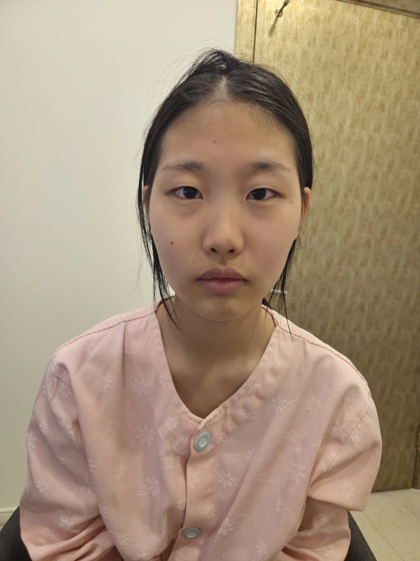 Eye-area comparison: before, treatment day and one month · Case 064 at Answer Plastic Surgery. Front view — before, eye-area comparison at Answer Plastic Surgery (case 064).