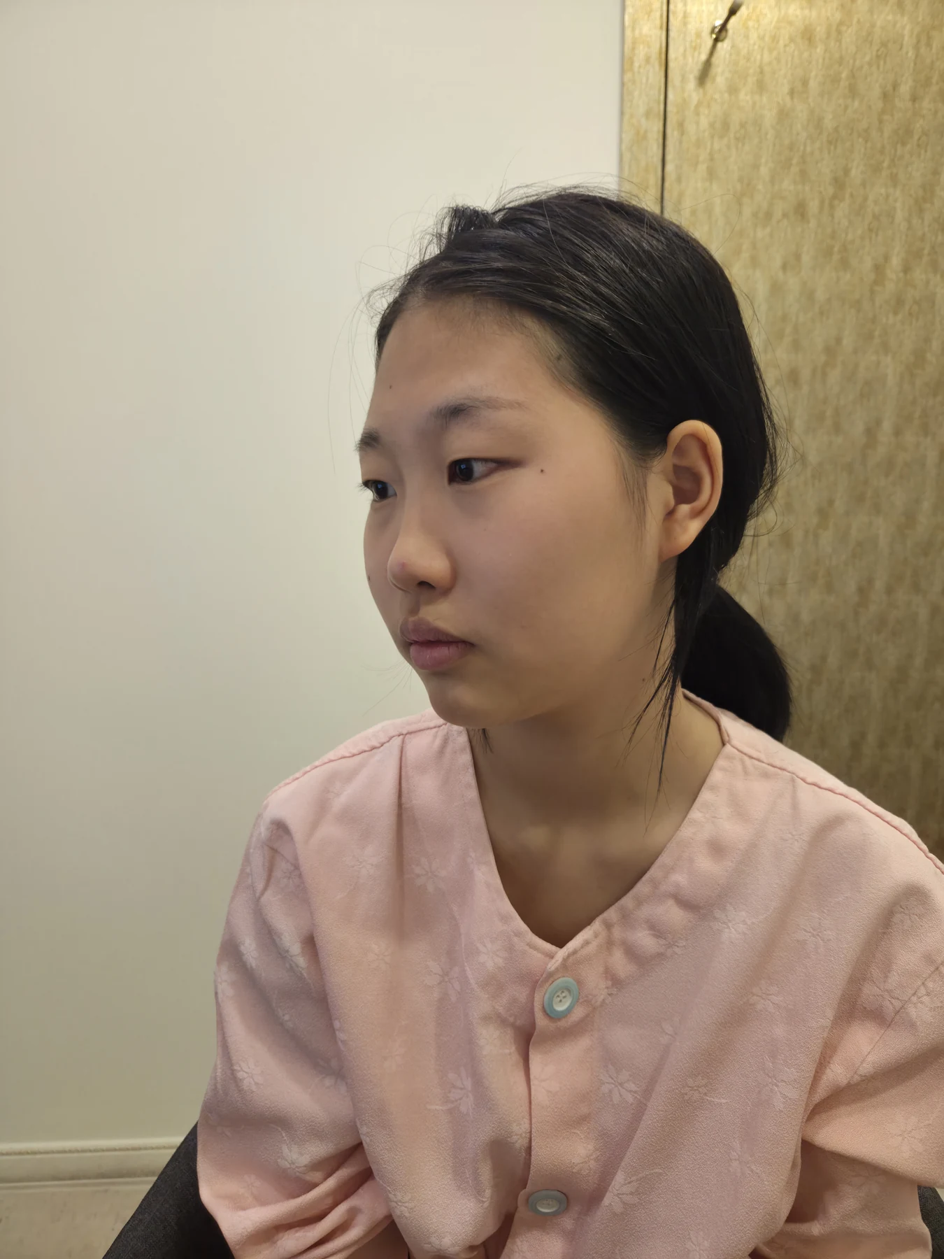 Eye-area comparison: before, treatment day and one month · Case 064 at Answer Plastic Surgery. Three-quarter view — before, eye-area comparison at Answer Plastic Surgery (case 064).