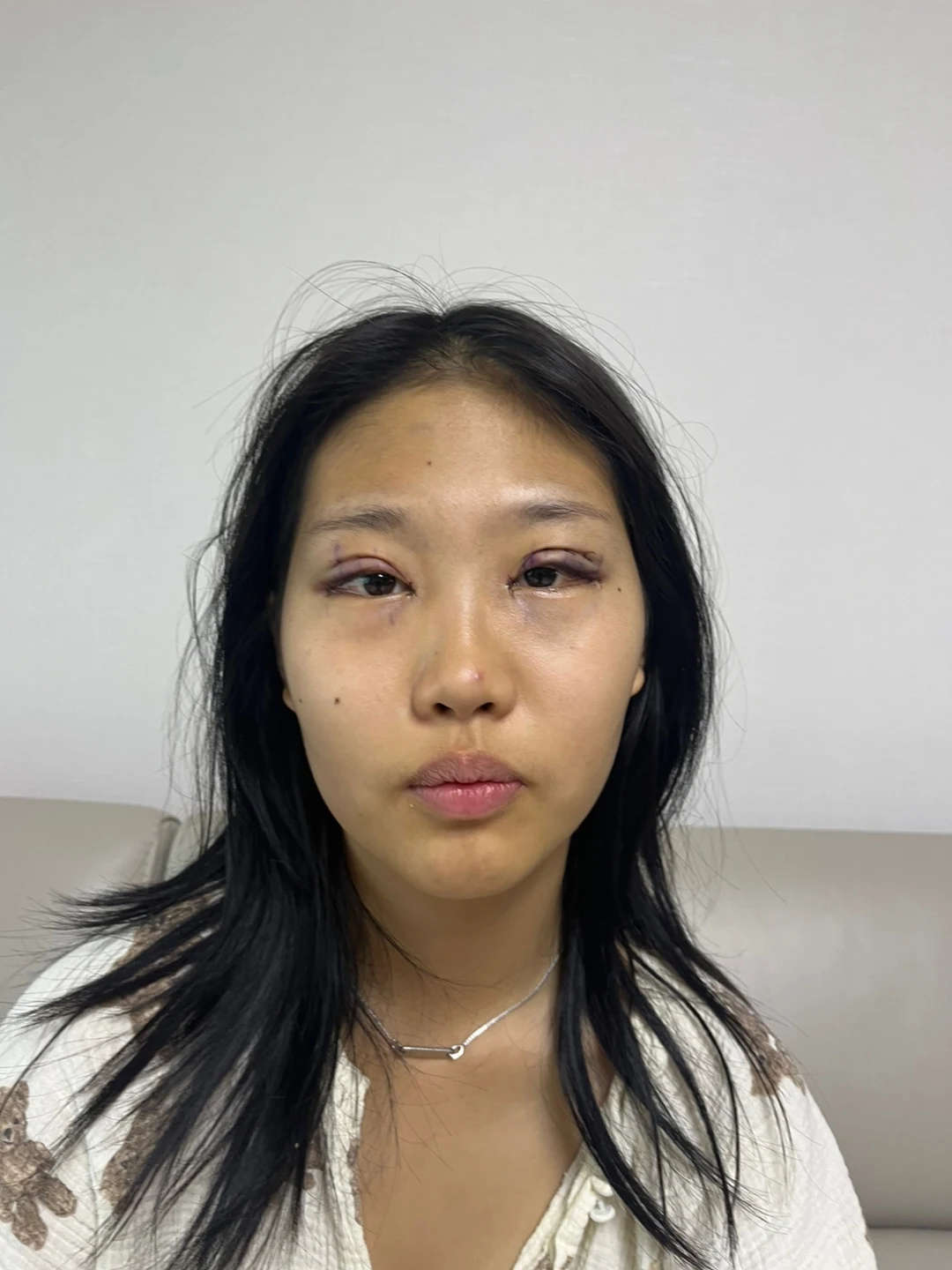 Eye-area comparison: before, treatment day and one month · Case 064 at Answer Plastic Surgery. Front view — treatment day, eye-area comparison at Answer Plastic Surgery (case 064).