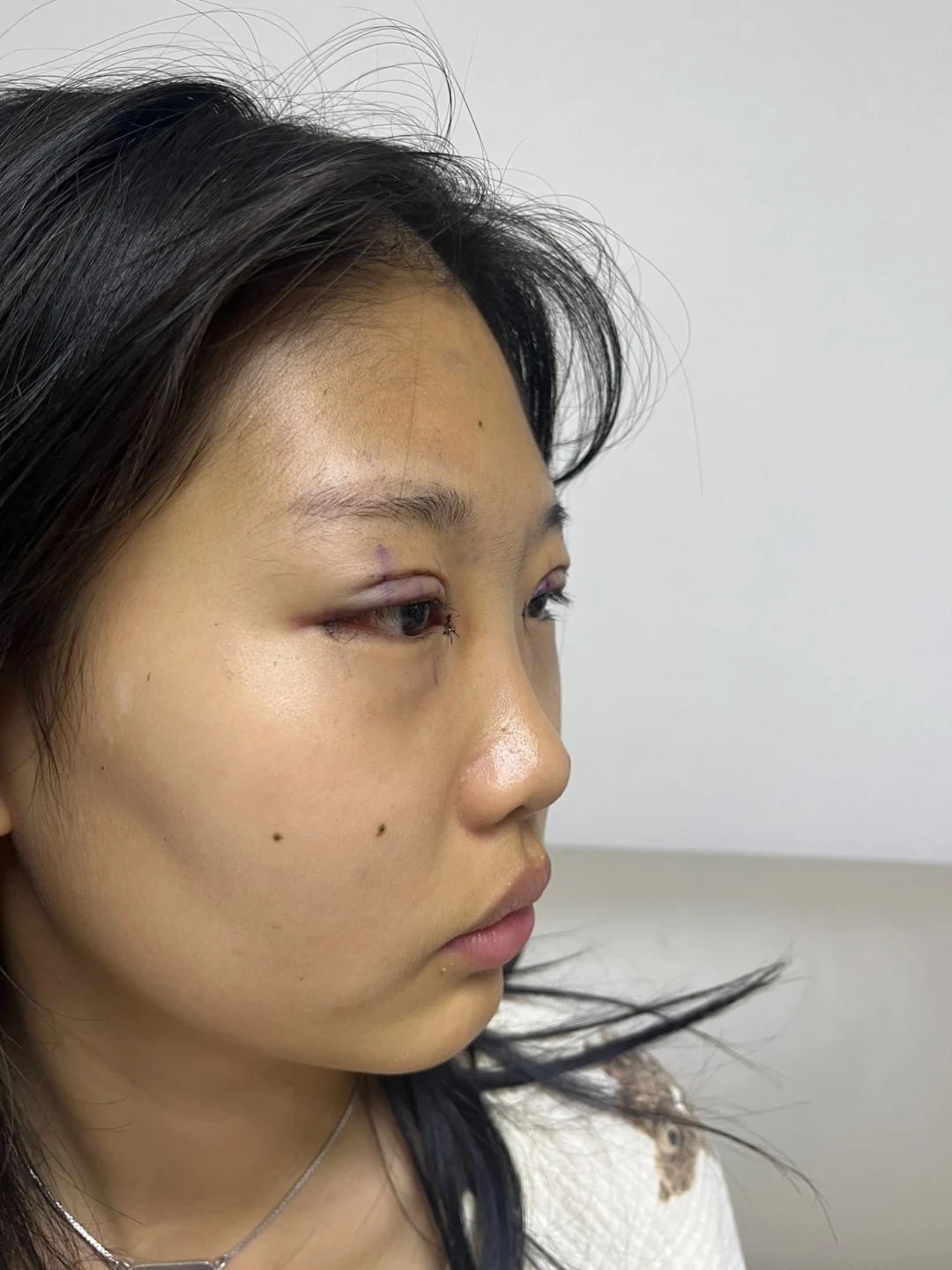 Eye-area comparison: before, treatment day and one month · Case 064 at Answer Plastic Surgery. Three-quarter view — treatment day, eye-area comparison at Answer Plastic Surgery (case 064).