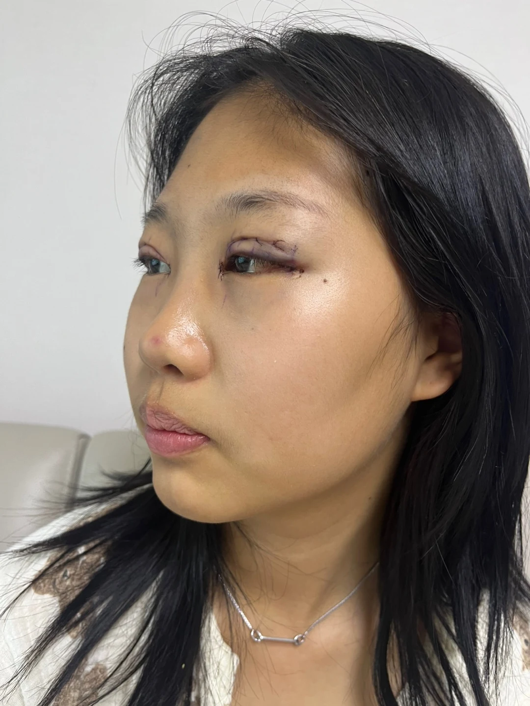 Eye-area comparison: before, treatment day and one month · Case 064 at Answer Plastic Surgery. Opposite three-quarter view — treatment day, eye-area comparison at Answer Plastic Surgery (case 064).