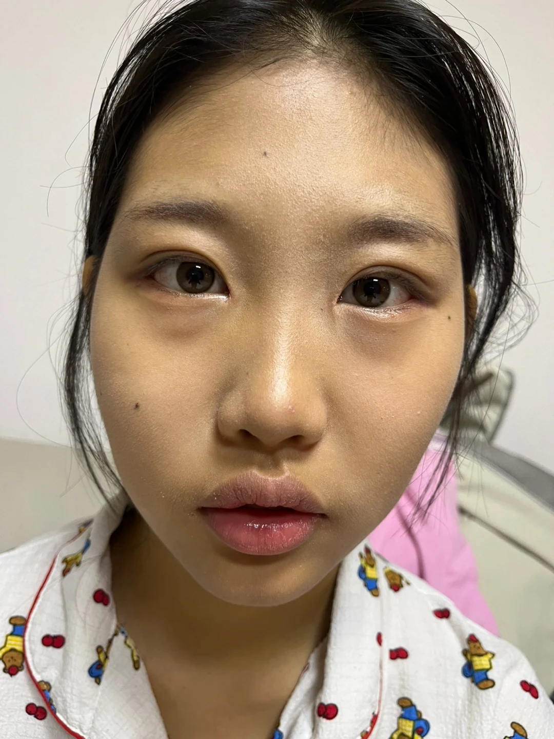 Eye-area comparison: before, treatment day and one month · Case 064 at Answer Plastic Surgery. Front view — 2 weeks, eye-area comparison at Answer Plastic Surgery (case 064).