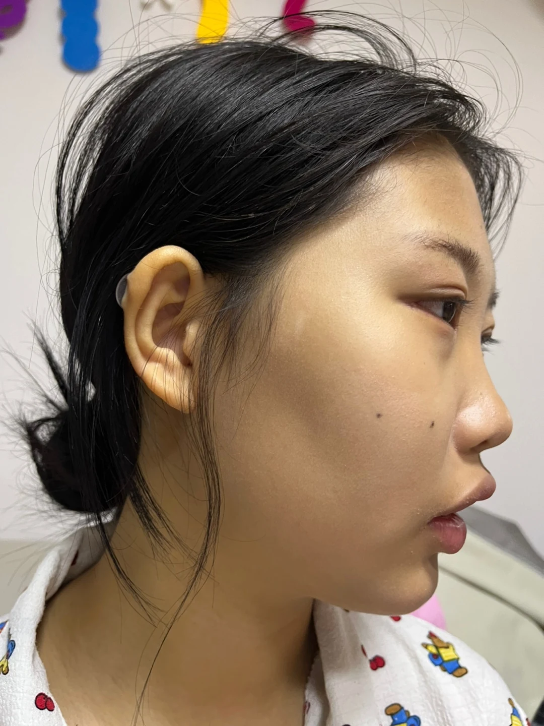 Eye-area comparison: before, treatment day and one month · Case 064 at Answer Plastic Surgery. Three-quarter view — 2 weeks, eye-area comparison at Answer Plastic Surgery (case 064).