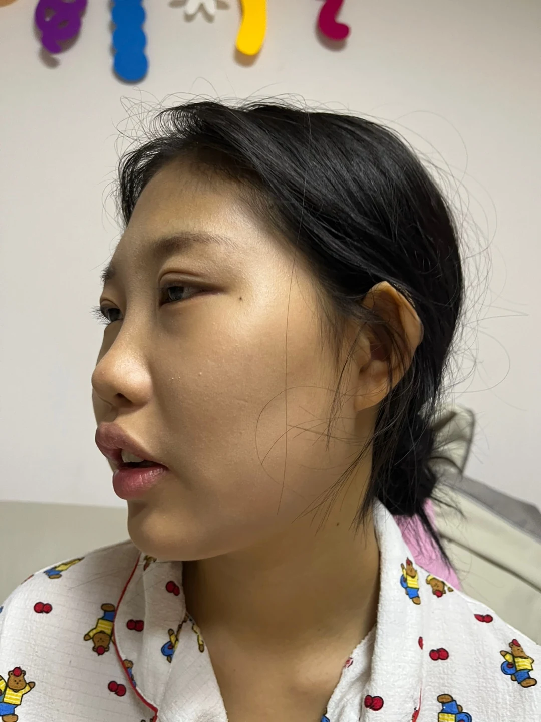 Eye-area comparison: before, treatment day and one month · Case 064 at Answer Plastic Surgery. Opposite three-quarter view — 2 weeks, eye-area comparison at Answer Plastic Surgery (case 064).