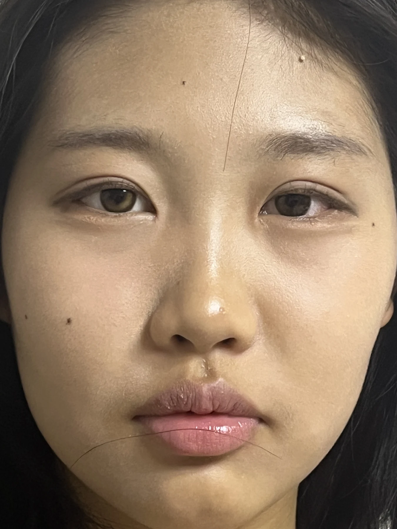 Eye-area comparison: before, treatment day and one month · Case 064 at Answer Plastic Surgery. Front view — 1 month, eye-area comparison at Answer Plastic Surgery (case 064).
