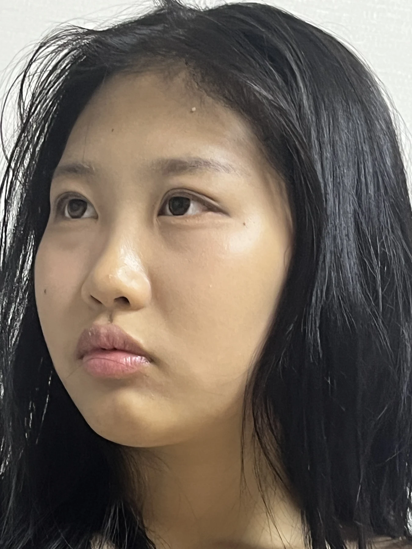 Eye-area comparison: before, treatment day and one month · Case 064 at Answer Plastic Surgery. Three-quarter view — 1 month, eye-area comparison at Answer Plastic Surgery (case 064).