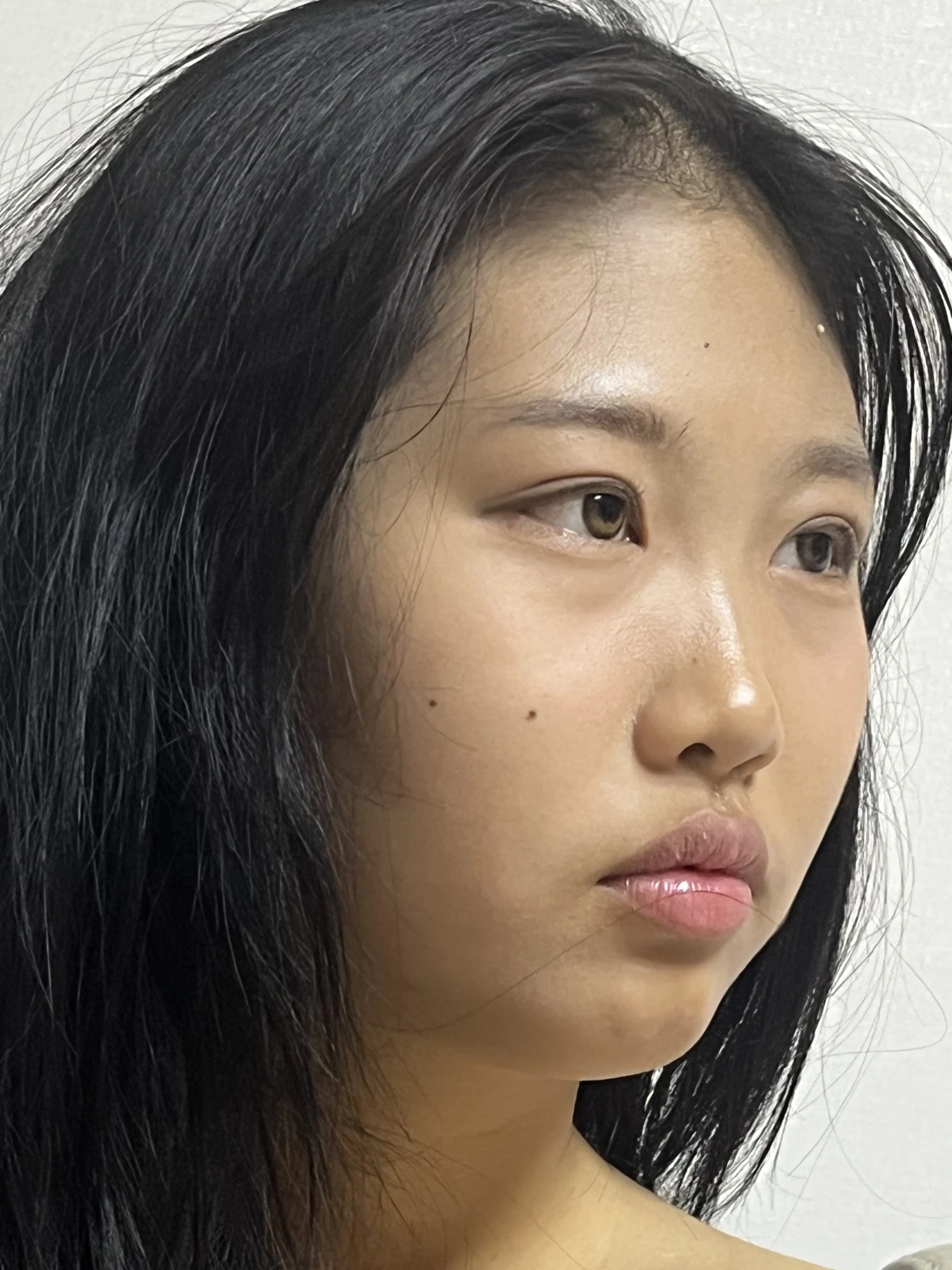 Eye-area comparison: before, treatment day and one month · Case 064 at Answer Plastic Surgery. Opposite three-quarter view — 1 month, eye-area comparison at Answer Plastic Surgery (case 064).