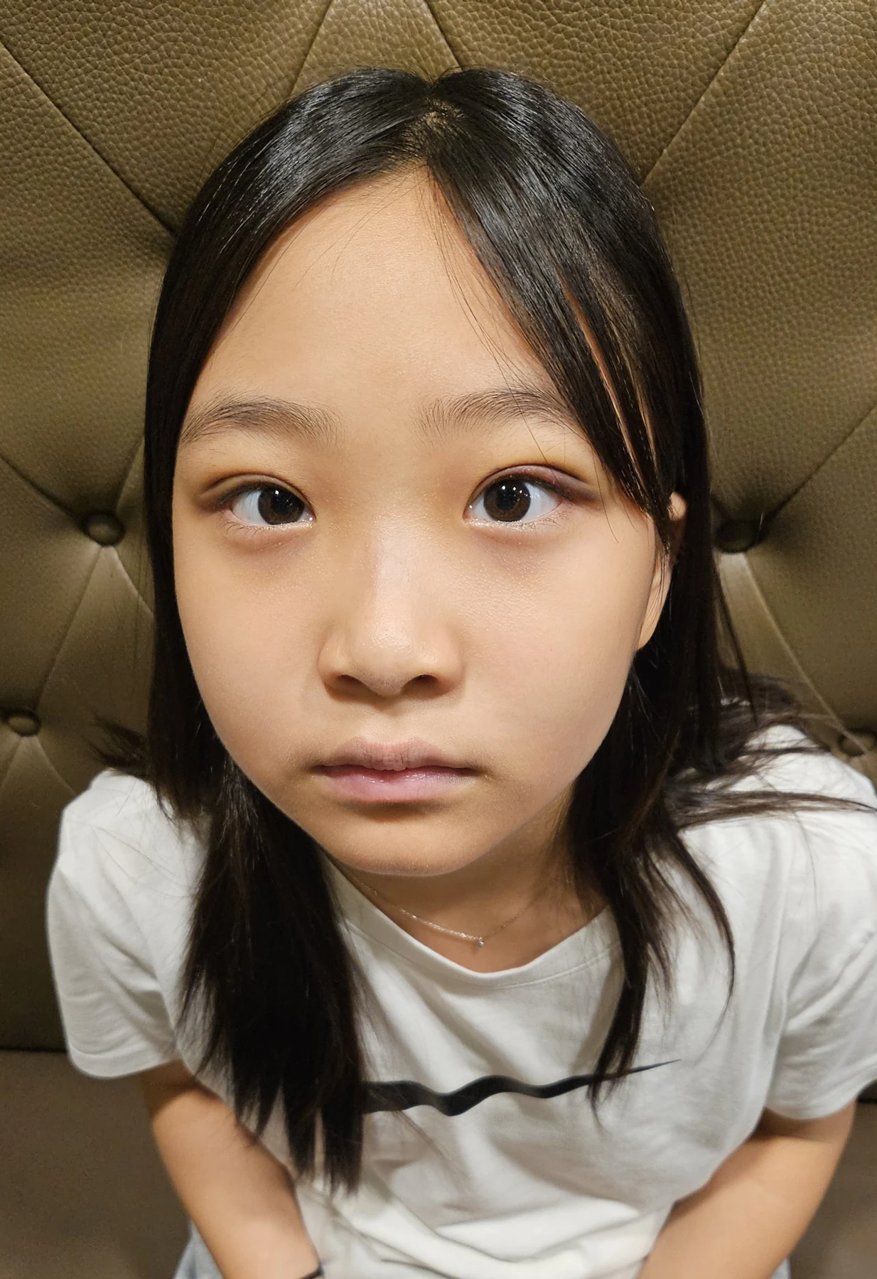 Eye-area surgery: a month of follow-up photographs · Case 065 at Answer Plastic Surgery. Front view — 1 week, eye-area surgery at Answer Plastic Surgery (case 065).