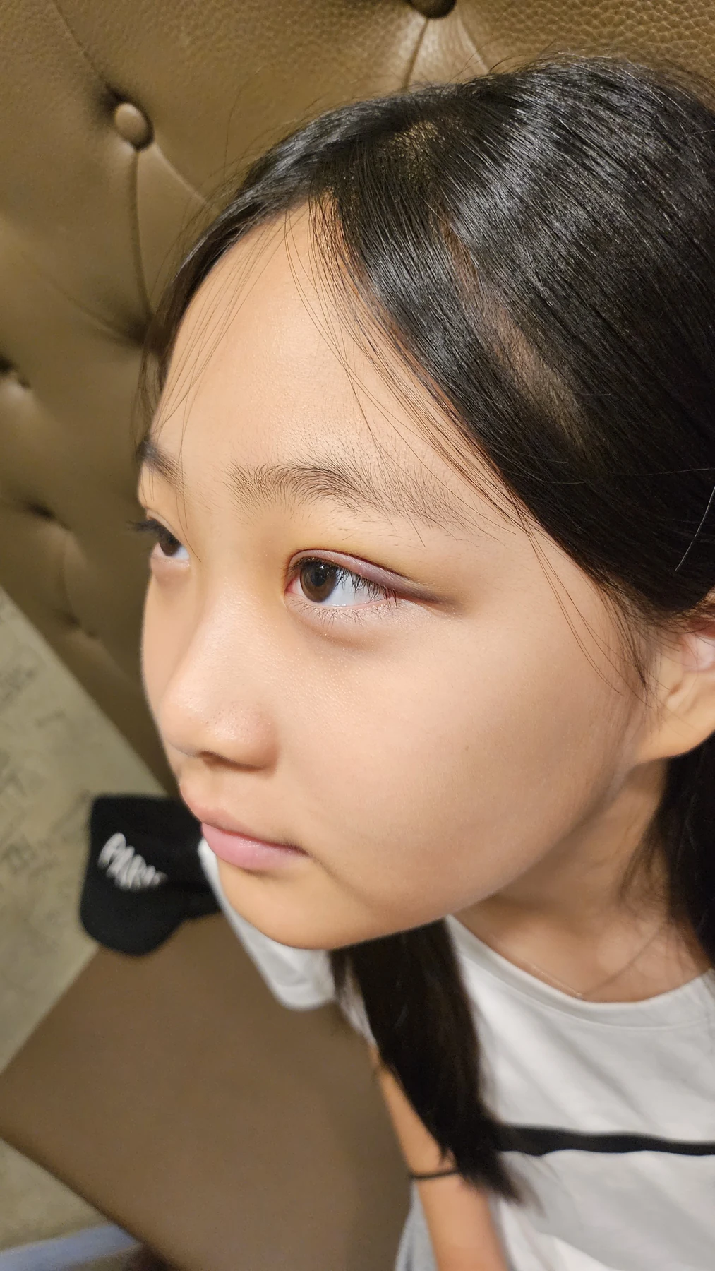 Eye-area surgery: a month of follow-up photographs · Case 065 at Answer Plastic Surgery. Three-quarter view — 1 week, eye-area surgery at Answer Plastic Surgery (case 065).