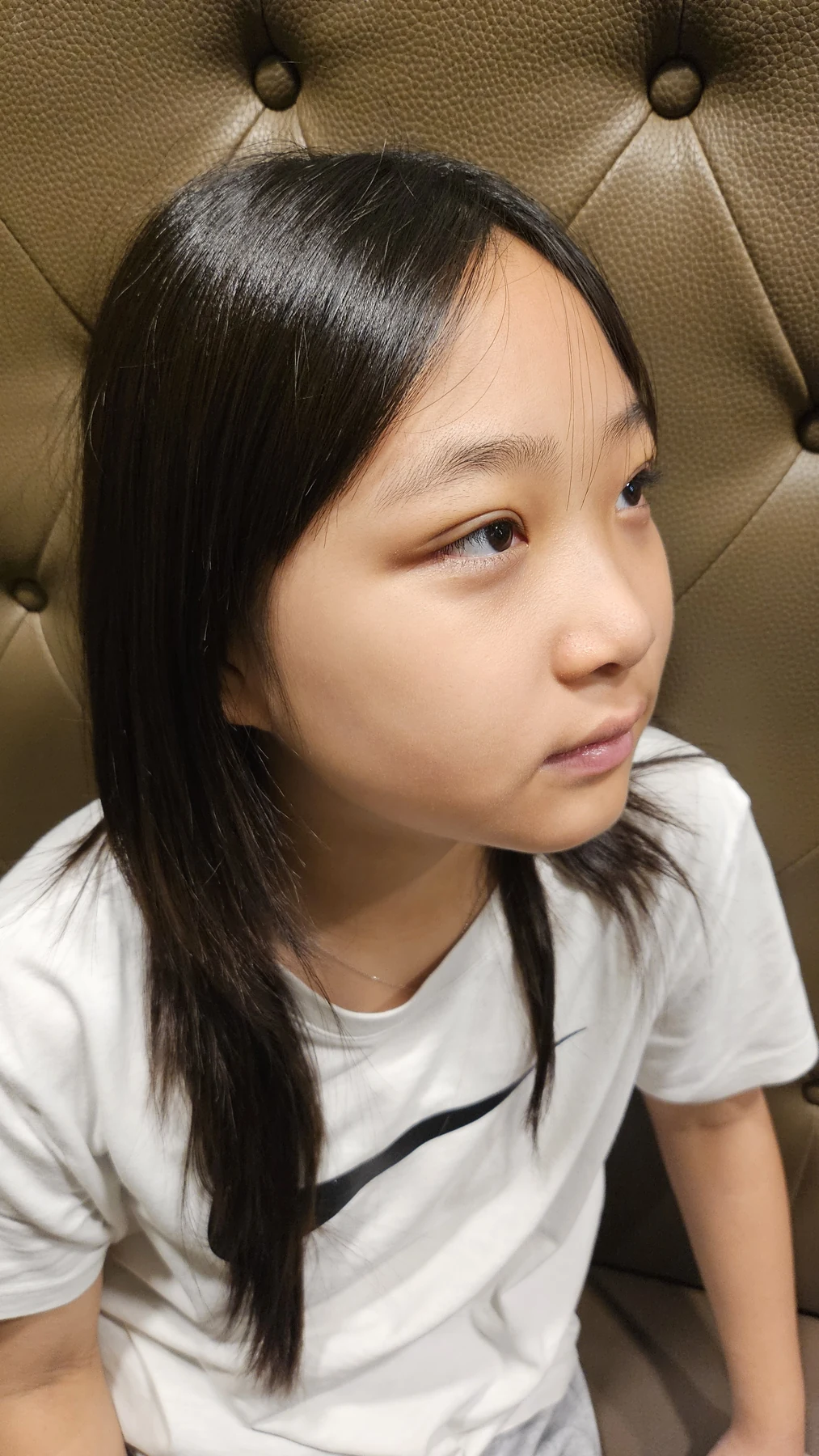Eye-area surgery: a month of follow-up photographs · Case 065 at Answer Plastic Surgery. Opposite three-quarter view — 1 week, eye-area surgery at Answer Plastic Surgery (case 065).