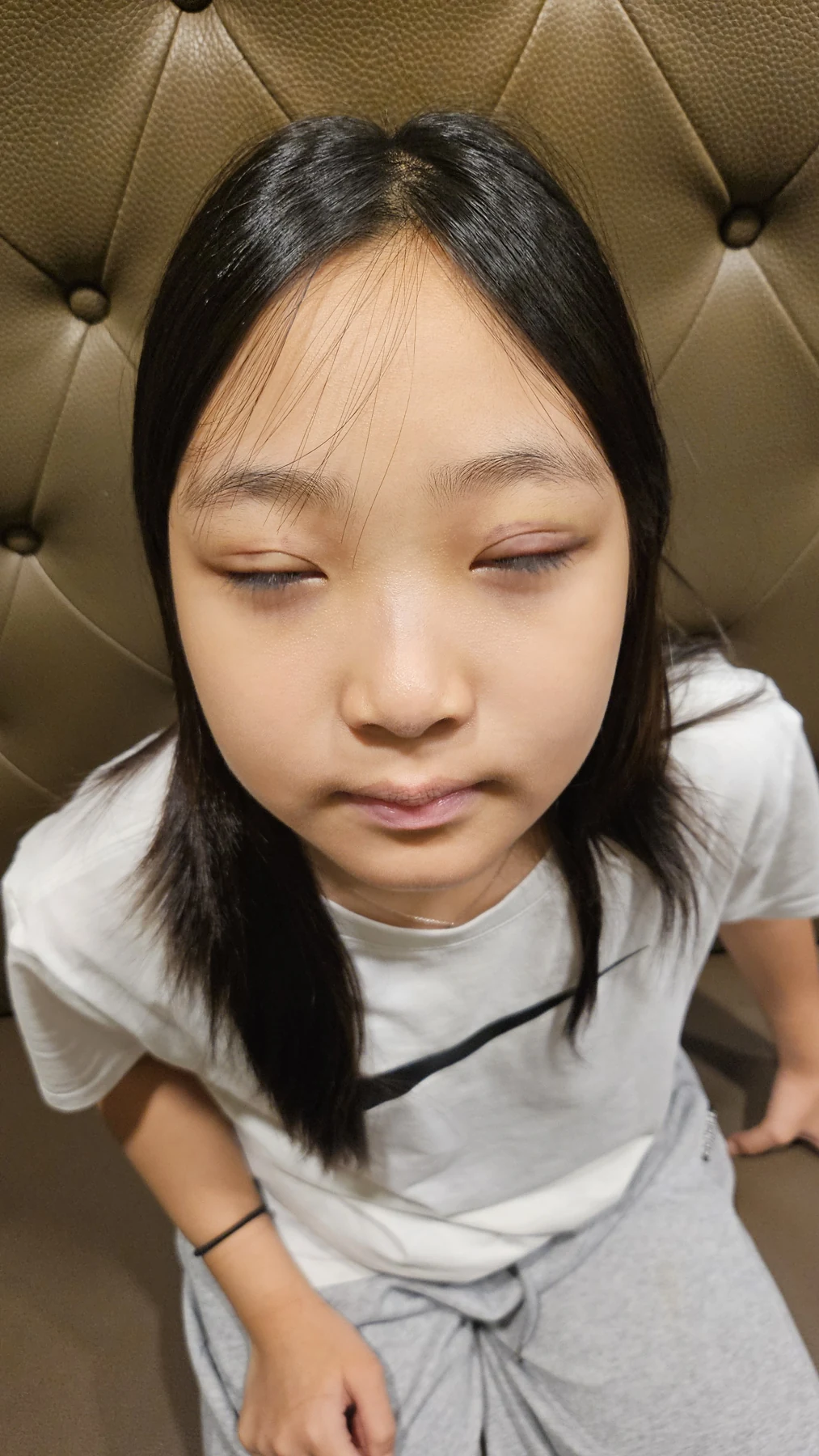 Eye-area surgery: a month of follow-up photographs · Case 065 at Answer Plastic Surgery. Eyes closed — 1 week, eye-area surgery at Answer Plastic Surgery (case 065).