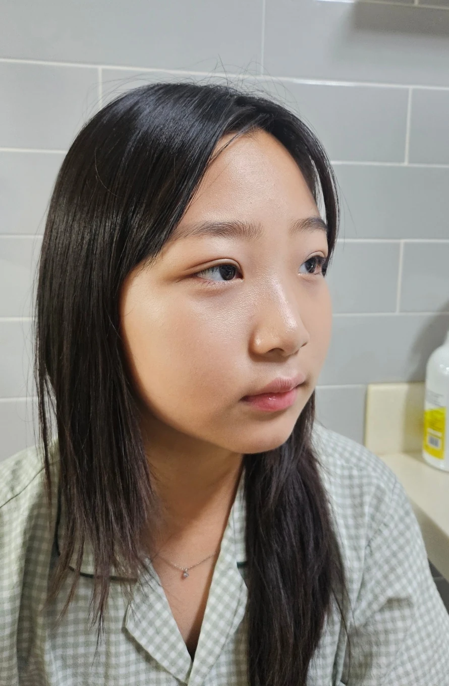 Eye-area surgery: a month of follow-up photographs · Case 065 at Answer Plastic Surgery. Opposite three-quarter view — 2 weeks, eye-area surgery at Answer Plastic Surgery (case 065).