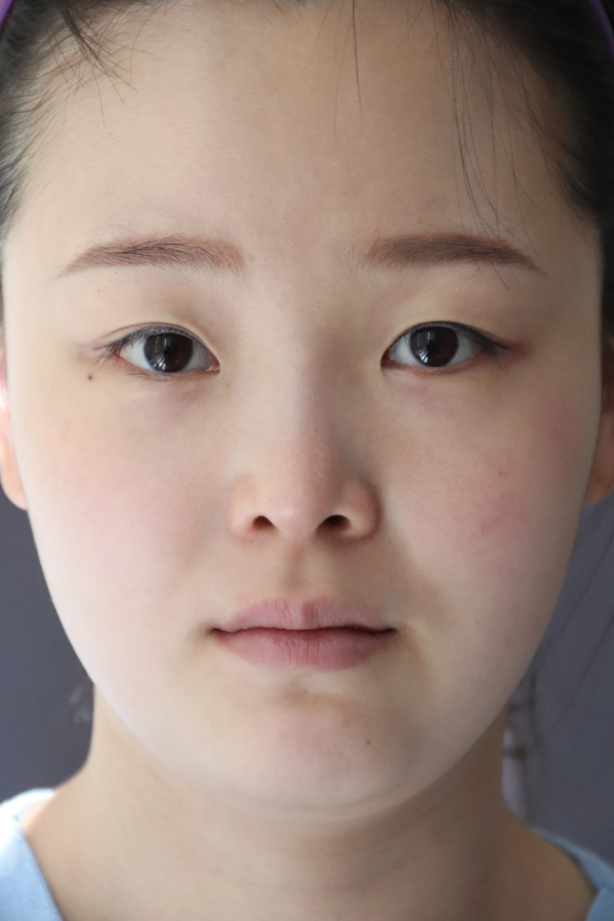 Eyelid and inner-corner surgery: six-month photo diary · Case 066 at Answer Plastic Surgery. Front view — before, eyelid and inner-corner surgery at Answer Plastic Surgery (case 066).