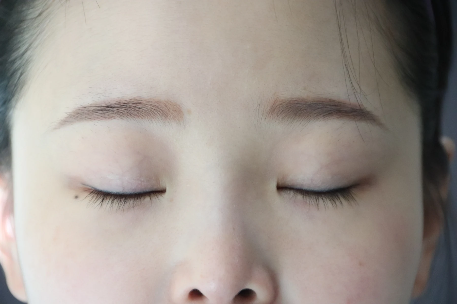 Eyelid and inner-corner surgery: six-month photo diary · Case 066 at Answer Plastic Surgery. Eyes-closed close-up — before, eyelid and inner-corner surgery at Answer Plastic Surgery (case 066).
