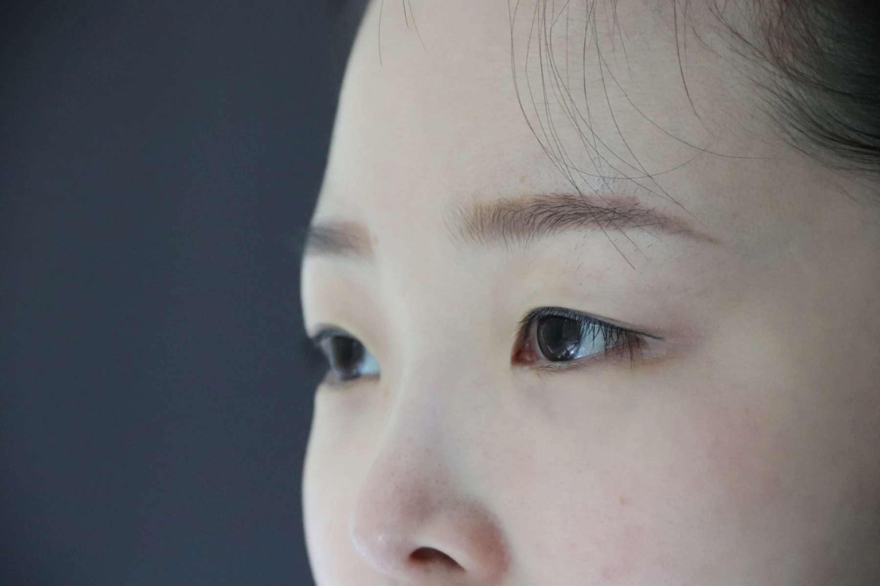 Eyelid and inner-corner surgery: six-month photo diary · Case 066 at Answer Plastic Surgery. Angled close-up — before, eyelid and inner-corner surgery at Answer Plastic Surgery (case 066).