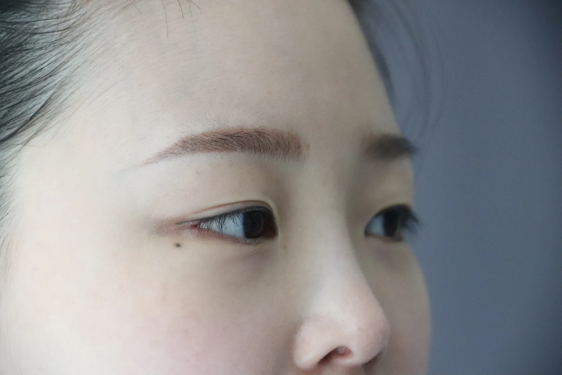 Eyelid and inner-corner surgery: six-month photo diary · Case 066 at Answer Plastic Surgery. Opposite angled close-up — before, eyelid and inner-corner surgery at Answer Plastic Surgery (case 066).
