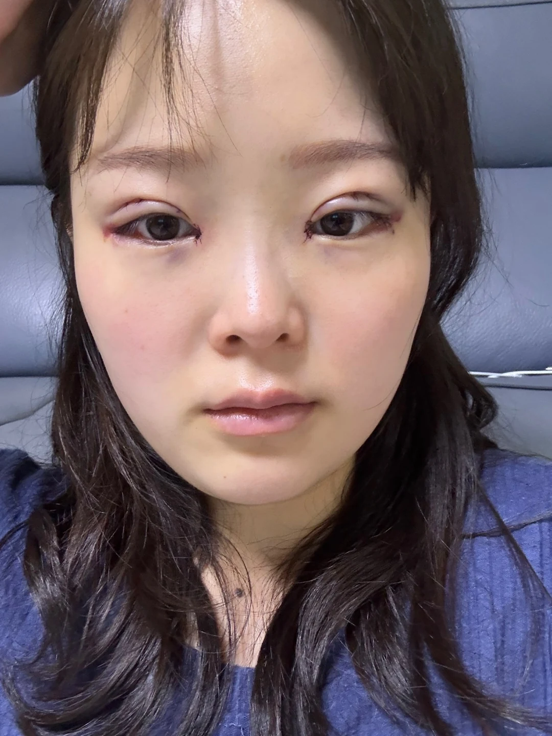 Eyelid and inner-corner surgery: six-month photo diary · Case 066 at Answer Plastic Surgery. Front view — day of surgery, eyelid and inner-corner surgery at Answer Plastic Surgery (case 066).