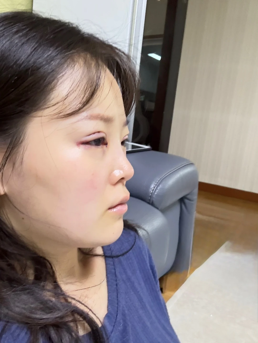 Eyelid and inner-corner surgery: six-month photo diary · Case 066 at Answer Plastic Surgery. Opposite angled view — day of surgery, eyelid and inner-corner surgery at Answer Plastic Surgery (case 066).