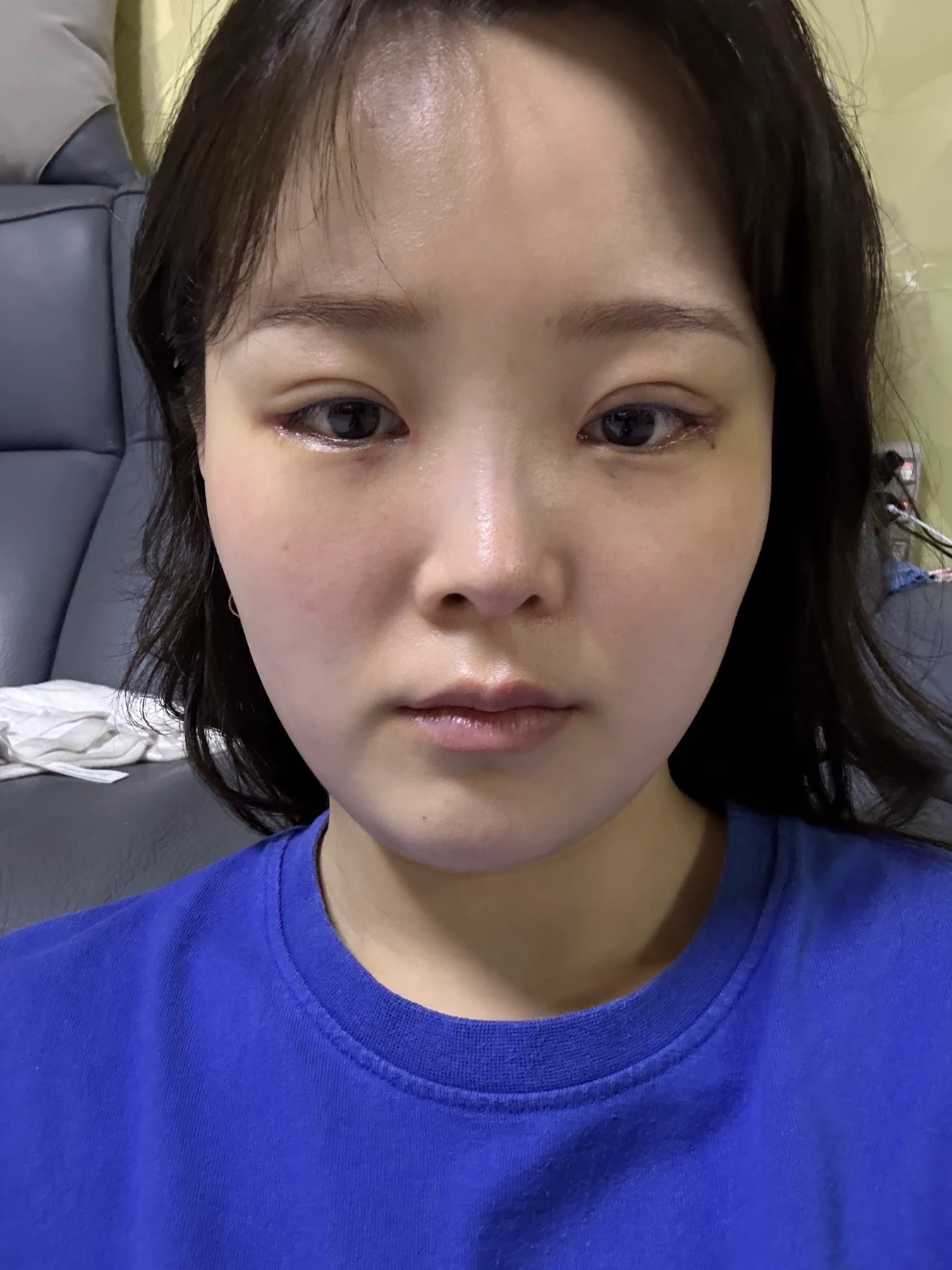 Eyelid and inner-corner surgery: six-month photo diary · Case 066 at Answer Plastic Surgery. Front view — 1 week, eyelid and inner-corner surgery at Answer Plastic Surgery (case 066).