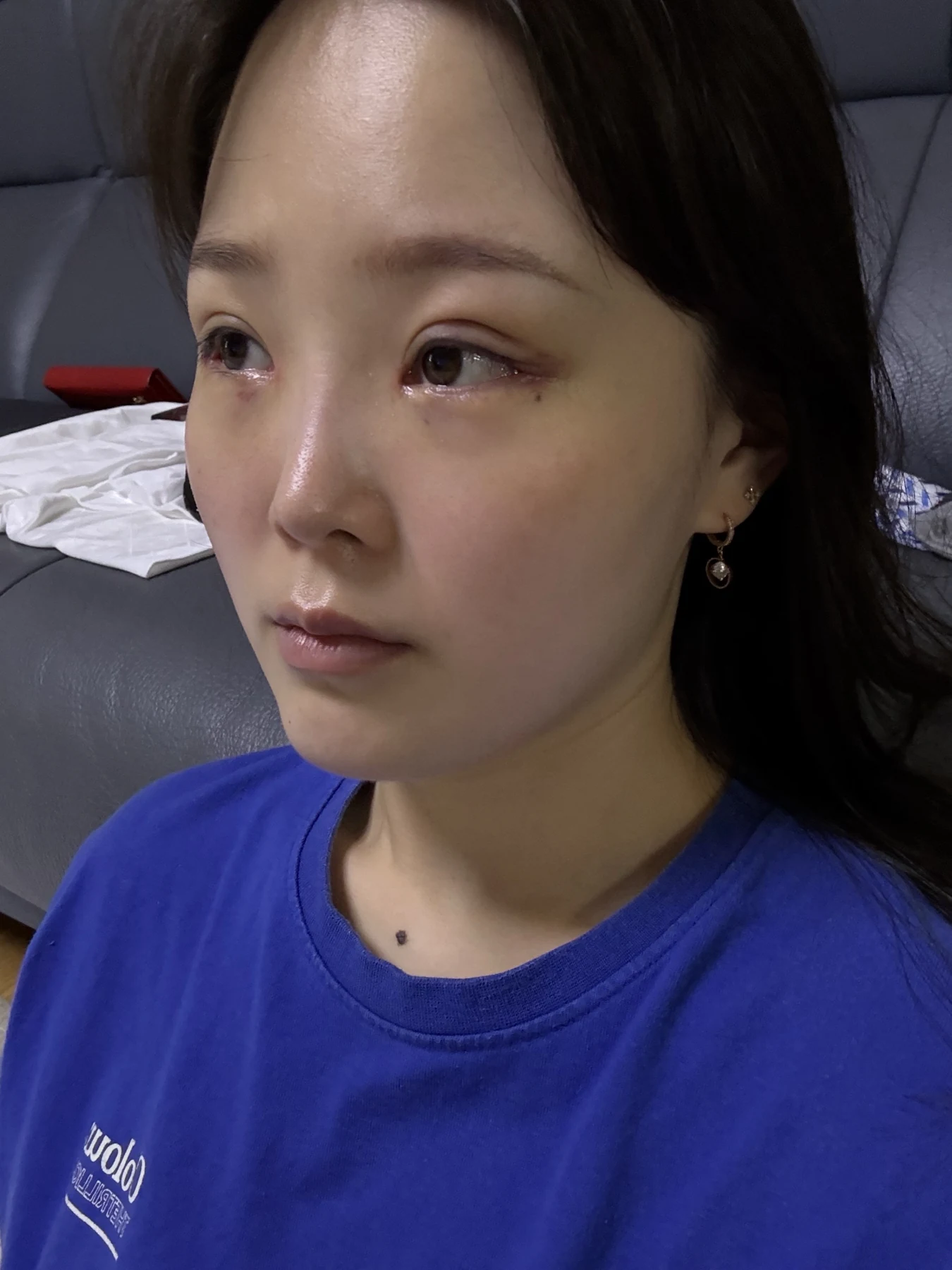 Eyelid and inner-corner surgery: six-month photo diary · Case 066 at Answer Plastic Surgery. Angled view — 1 week, eyelid and inner-corner surgery at Answer Plastic Surgery (case 066).